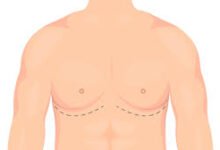 Gynecomastia in Dubai