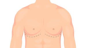 Gynecomastia in Dubai